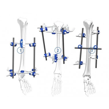 Tibia Fixation