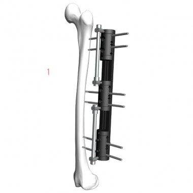 LRS Fixator