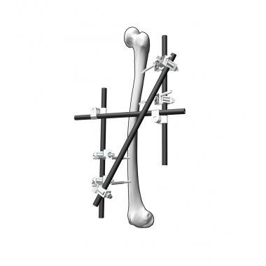 Femur Fixation