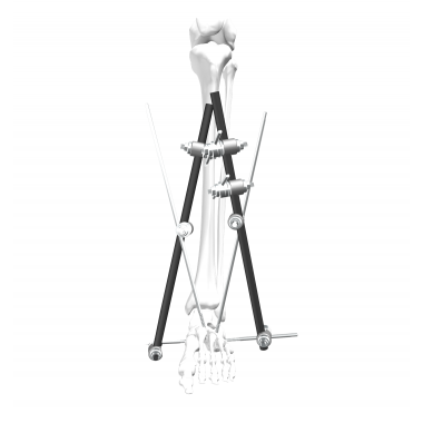 Ankle Fixation