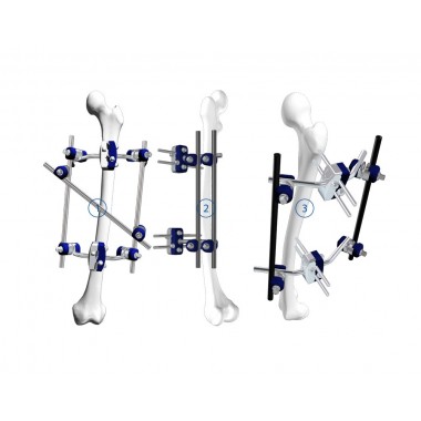 Femur Fixation