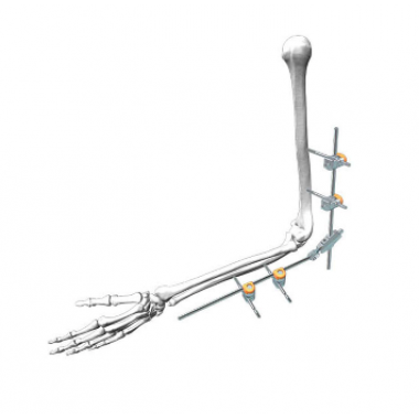 Children's Elbow Fixation