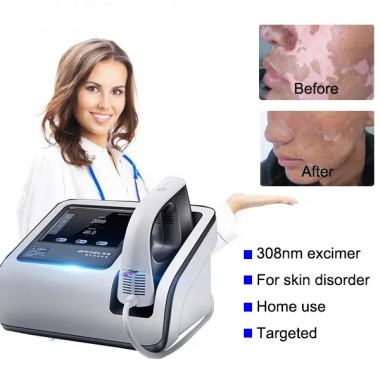 Kernel excimer laser 308nm trageted UVB phototherapy for psoriasis vitiligo treatment