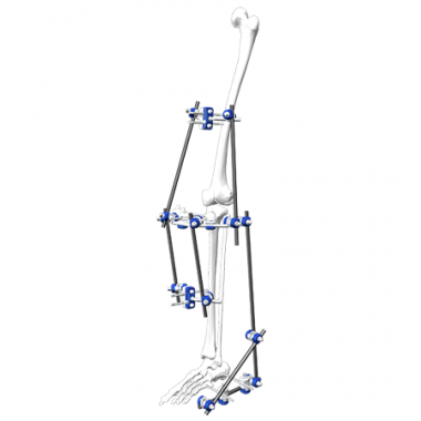 Hybrid Fixation