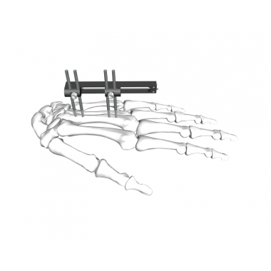 Metacarapale Fixator