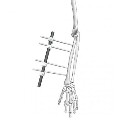 Radius Fixation