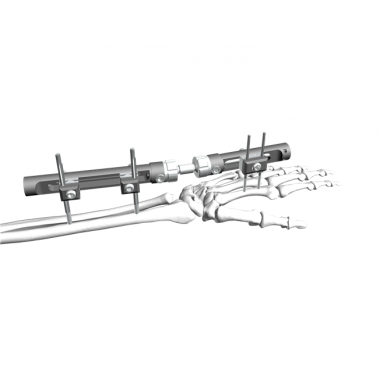Distal Radius Fixator