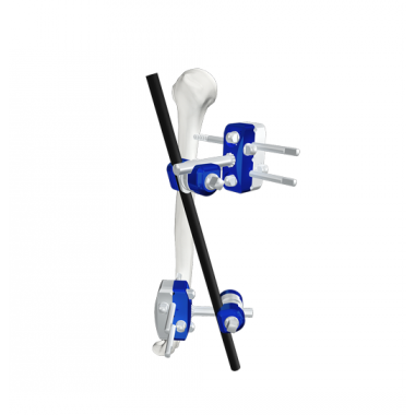 Humerus Fixation