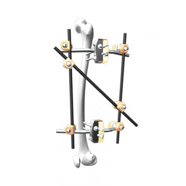 Children's Femur Fixation