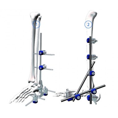 Ankle Joint Fixation