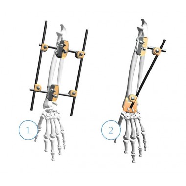 Radius Fixation