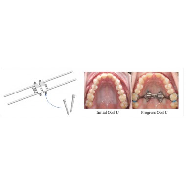 Maxillary Skeletal Expander